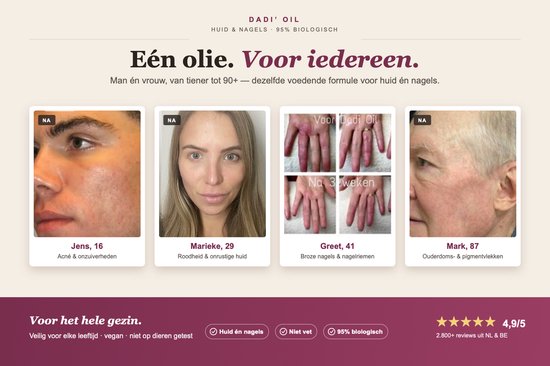 Vier afbeeldingen: Jens (16) met acné, Marieke (29) met rode huid, handen van Greet (41) voor en na 3 weken, en Mark (87) met pigmentvlekken.