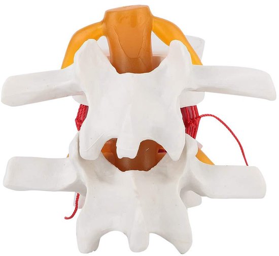 1.5X Medisch Demonstratiemodel van de Lumbale Wervelkolom – Hernia Model met Zachte Elastomeer Tussenwervelschijf, Lichtgewicht Leerhulpmiddel