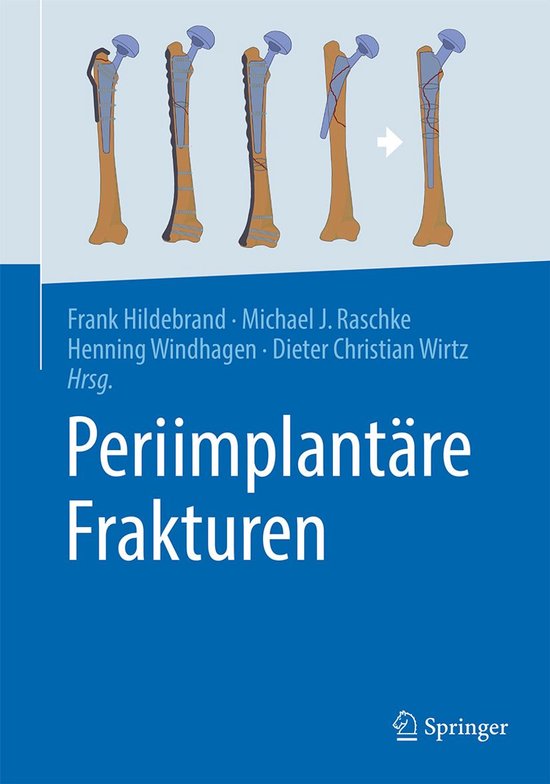 Medicine (German Language) - Periimplantäre Frakturen - cover