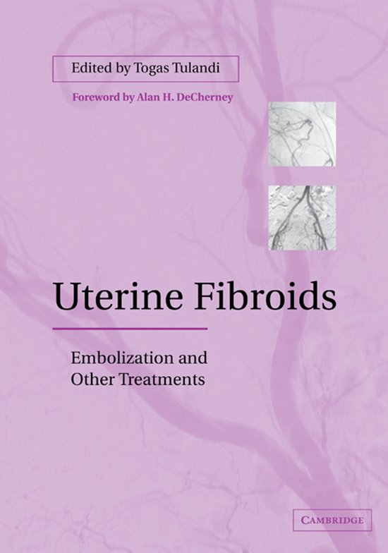 Uterine Fibroids - cover