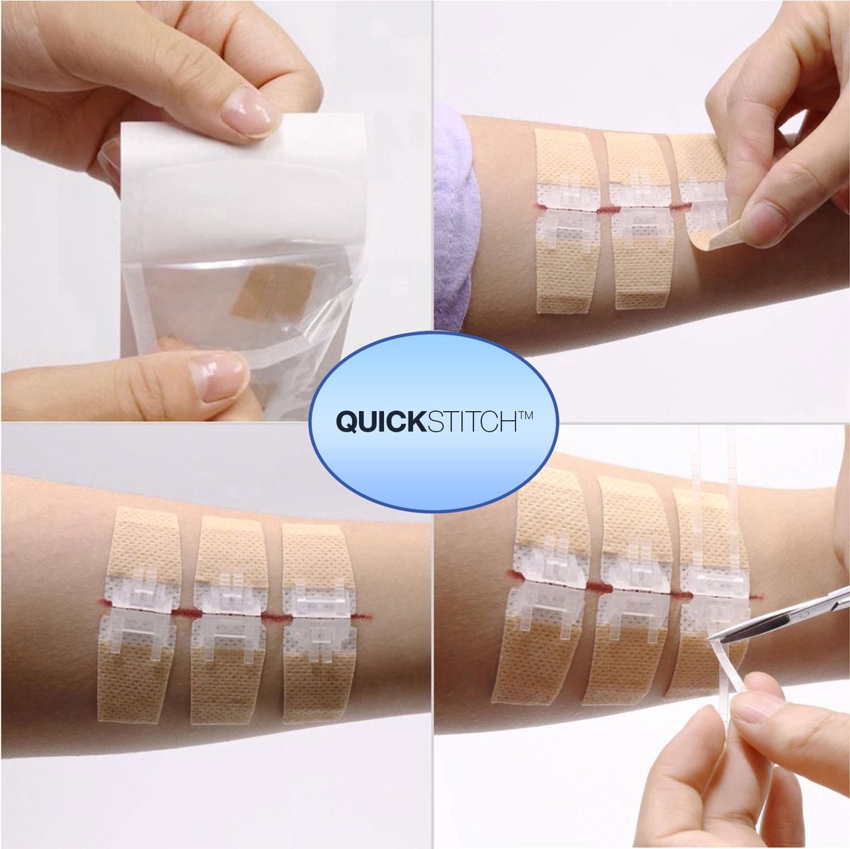Goedkoopste QuickStitch Enkele Hechtpleister – Naaldloze Hechting – pleister voor diepe wonden - pleisters – zelf hechtpleister – snelle manier om wonden af te sluiten – NU 5 stuks !