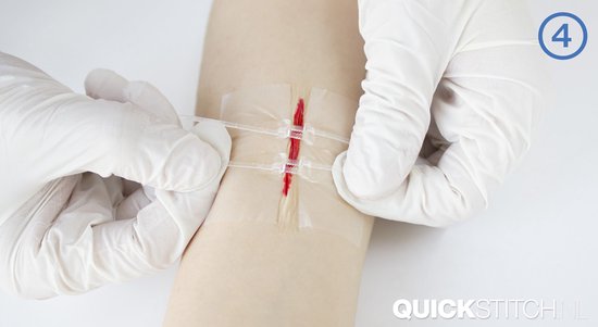 QuickStitch dubbele Hechtpleister – Naaldloze Hechting – pleister voor