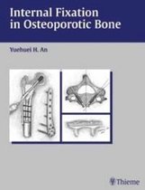 Internal Fixation in Osteoporotic Bone