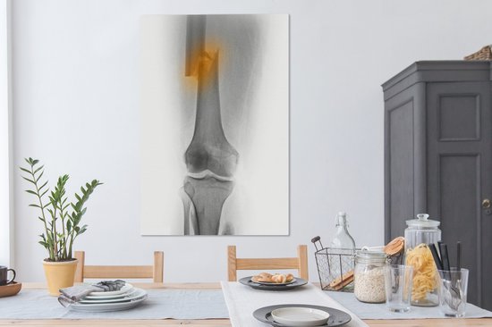 Radiographie de la cuisse d'un homme de 30 ans impliqué dans un accident de moto 80x120 cm - Tirage photo sur toile (Décoration murale salon / chambre)