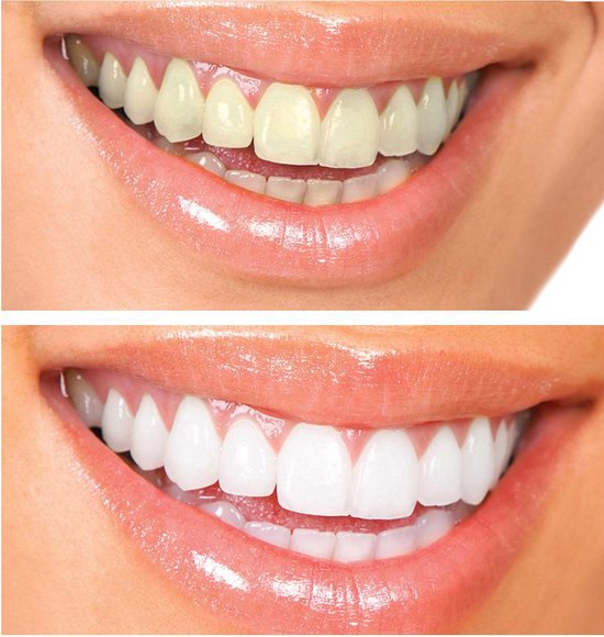 Afwijking Kiezen een beetje Tandenbleekset - inclusief Teeth Whitening Strips + Wipes + 3 Gelspuiten -  Zonder... | bol.com