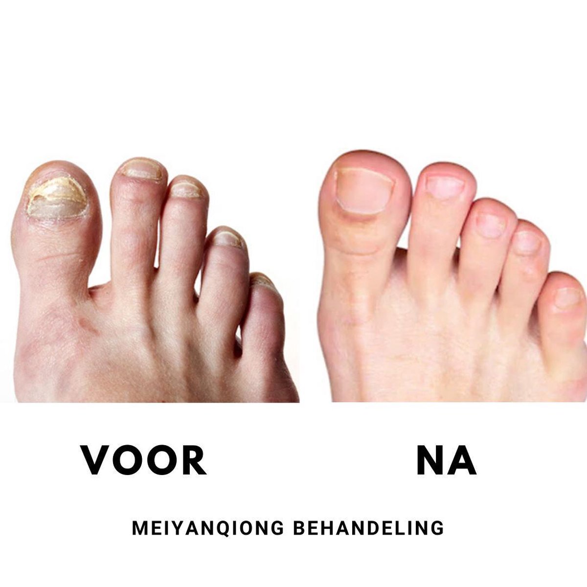 De stad bijeenkomst Verdeelstuk Anti Nagel schimmel creme - Medicijn tegen nagel schimmel - voeten  verzorging -... | bol.com