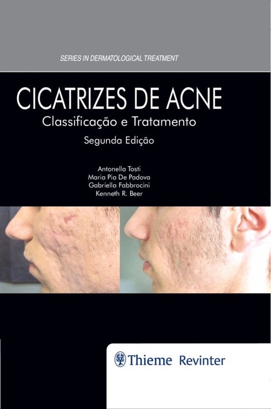 Cicatrizes de Acne - cover