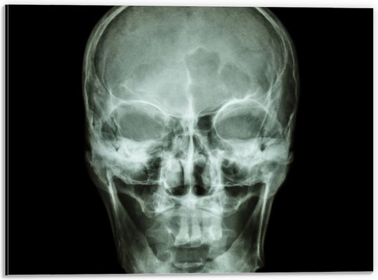 Dibond - Röntgenfoto van Mensenschedel - 40x30 cm Foto op Aluminium (Met Ophangsysteem)