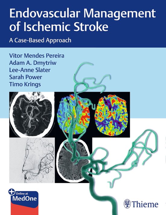 Endovascular Management of Ischemic Stroke - cover