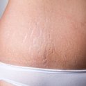 Gedetailleerde close-up van een huid met verschillende striae, met een witte slip aan de onderkant.