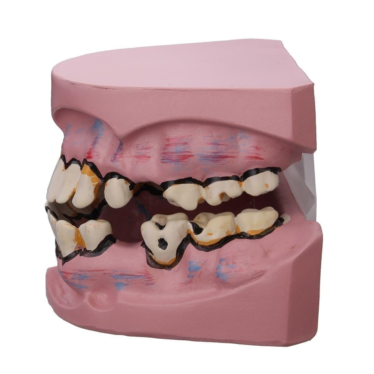 Modèle de dents de maladie Dental modèle de dent orale modèle Medisch  implantation de