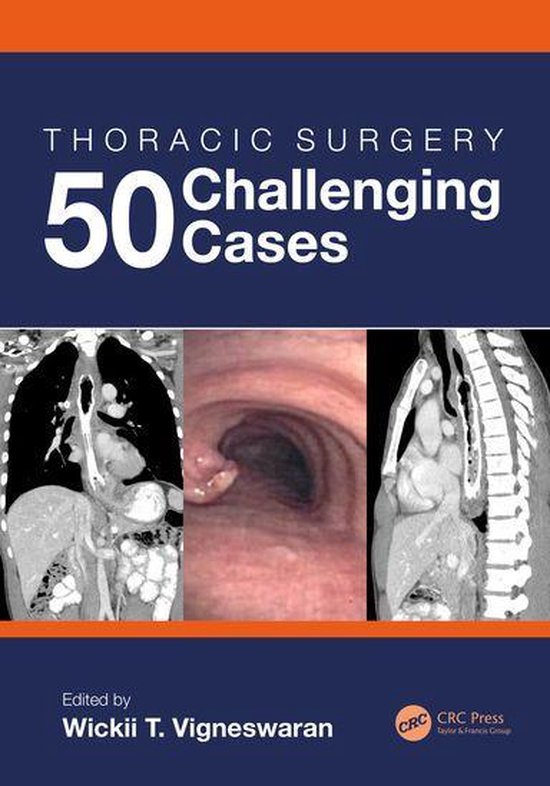 Thoracic Surgery: 50 Challenging cases - cover