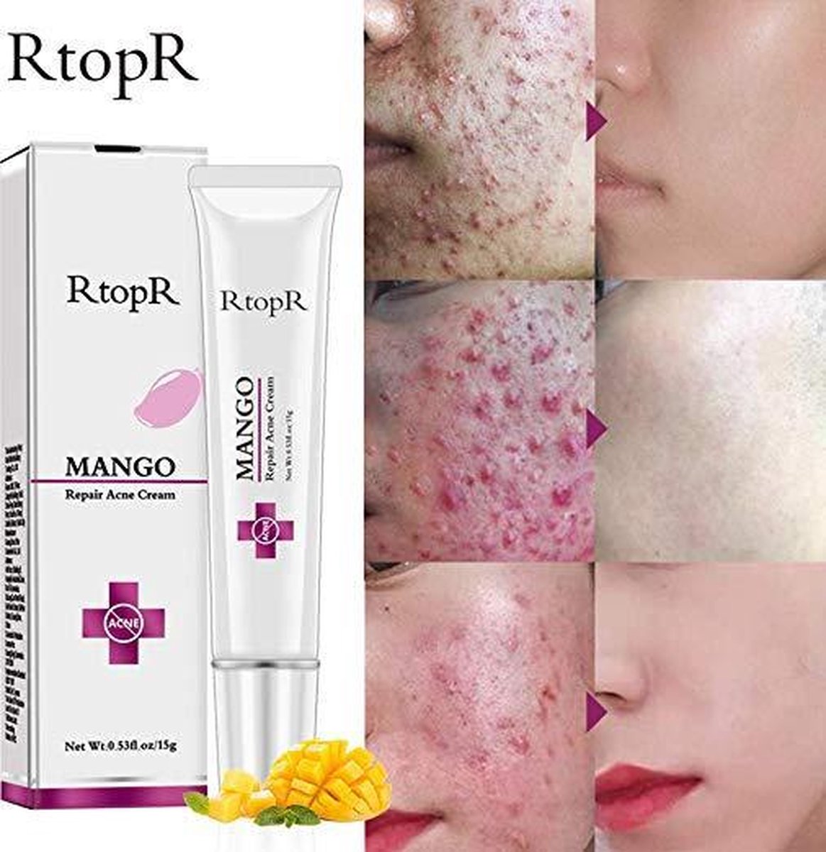 Groet gesmolten viool Mango Acne Crème bij littekens, puistjes, mee-eters, zwart pigment en  onzuiverheden | bol.com