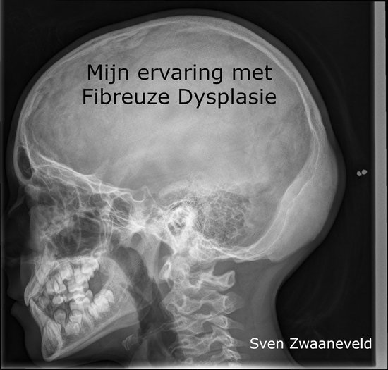 mijn-ervaring-met-fibreuze-dysplasie-kennis-en-hoop-over-de-ziekte-bol