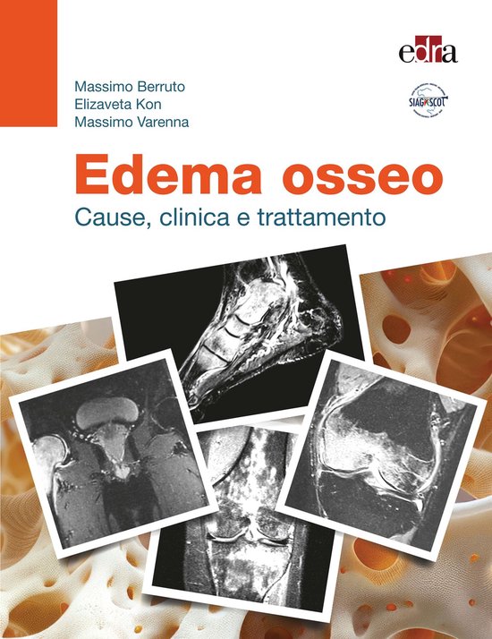 Edema osseo - cover