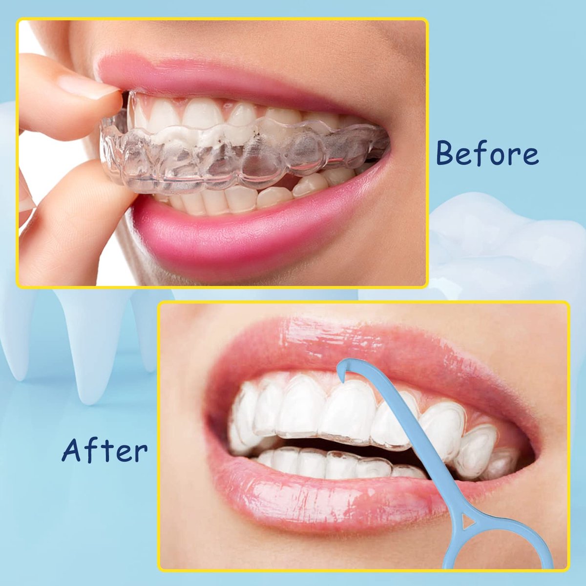 Aligner Remover Tool – Beugel Verwijder tool voor Clear Aligners – Geschikt voor invisalign - Hygienisch en Herbruikbaar - 1 stuk