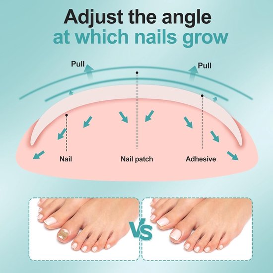 Set voor het corrigeren van ingegroeide teennagels met nagelsteun en pleisters voor grote tenen — afbeelding 3