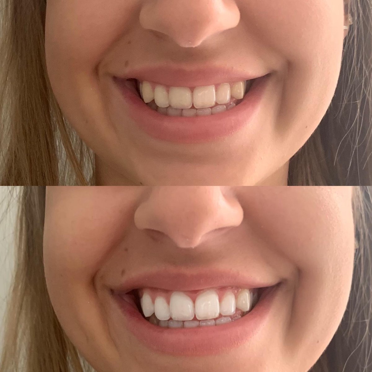 overschrijving Groene achtergrond kans Optimal White® Tandenbleekset - Thuis 100% Veilig Tanden Bleken - Witte  Tanden - Teeth... | bol.com