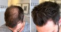 Vergelijking van mannelijk haar voor en na het gebruik van IMPERIO haarvezels. Toont meer volume en dikte.