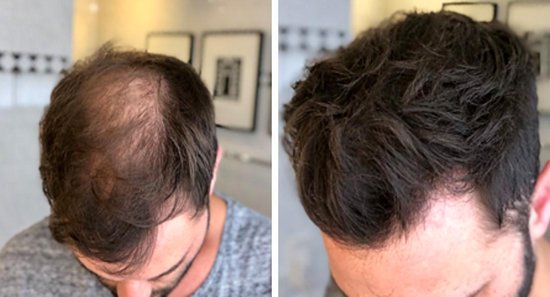 Vergelijking van mannelijk haar voor en na het gebruik van IMPERIO haarvezels. Toont meer volume en dikte.