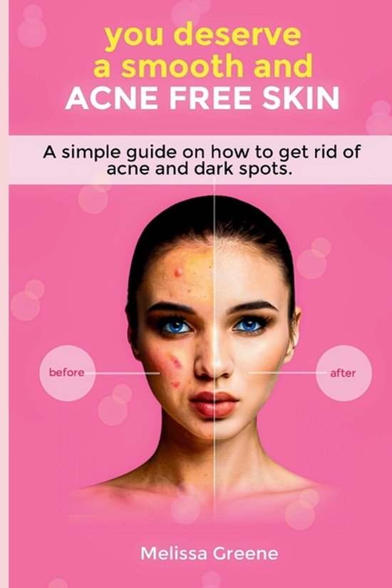 you deserve a smooth and acne free skin - cover