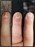 Vóór, tijdens en na behandeling van een duim met Dadi'Oil, met verbetering van de nagelriem.