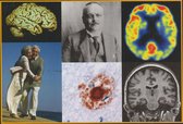 Atlas of Alzheimer's Disease