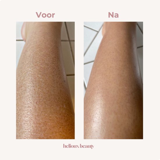 Voor- en nafoto van een huid met droge, schilferige huid die glad en gehydrateerd is na gebruik.
