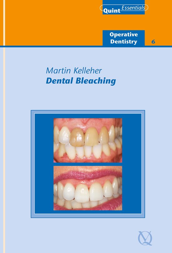 Dental Bleaching (ebook), Martin Kelleher 9781850973195 Boeken