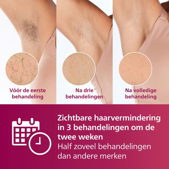 Vergelijking van oksels: vóór de eerste behandeling, na drie behandelingen en na volledige behandeling.