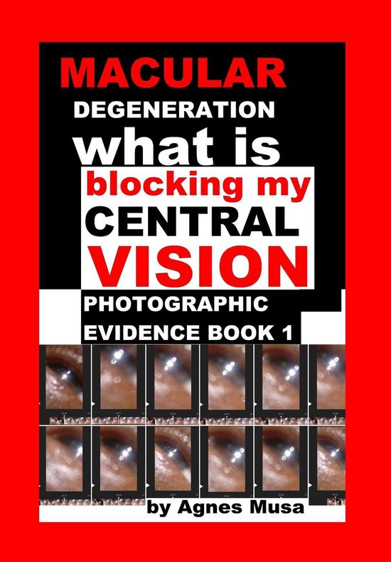 Macular Degeneration, What Is Blocking My Central Vision, Photographic ...