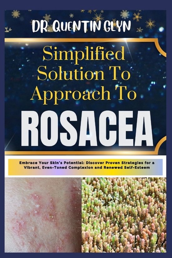 Simplified Solution Approach To ROSACEA - cover