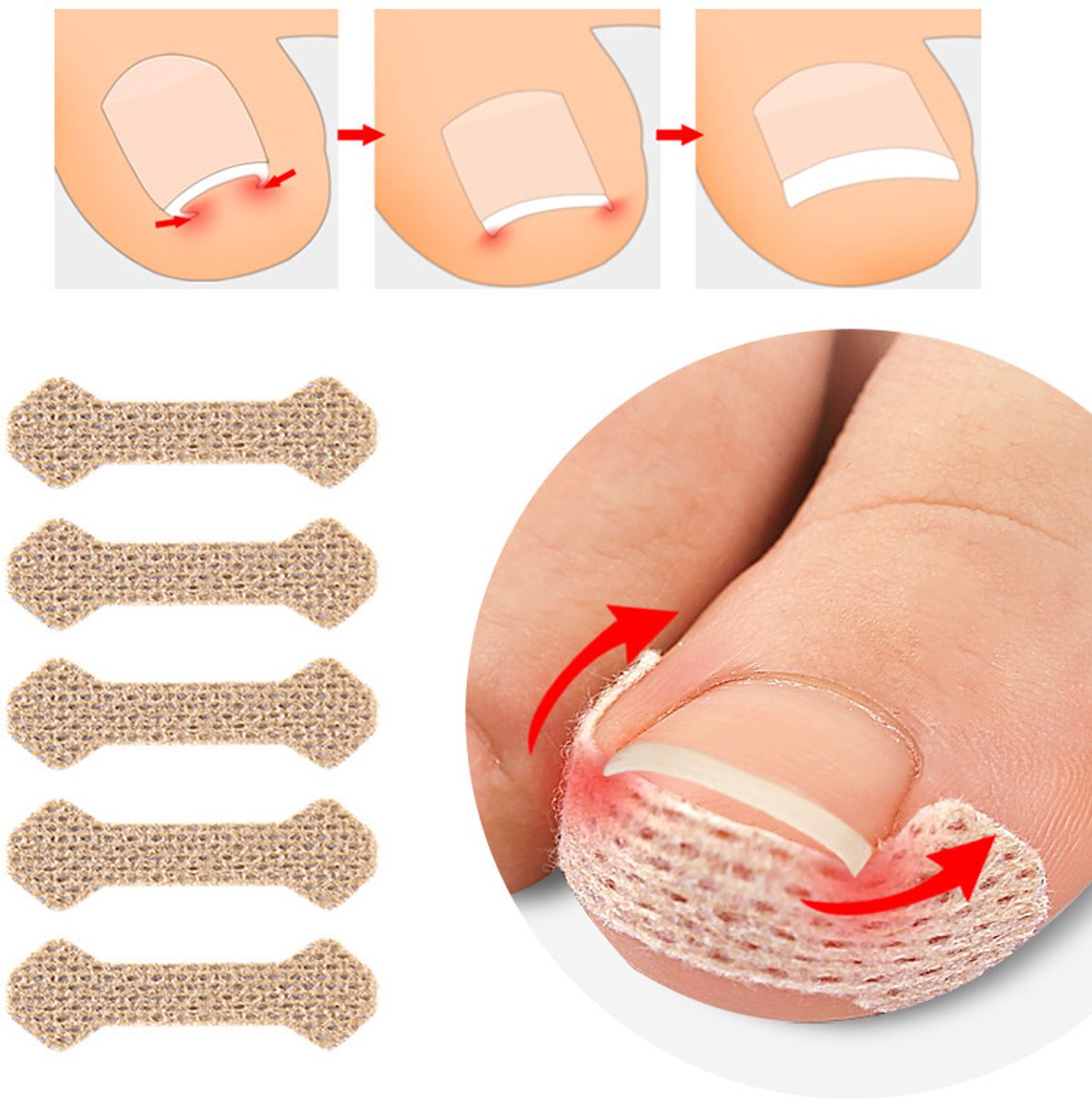 Pleister voor ingegroeide teennagels