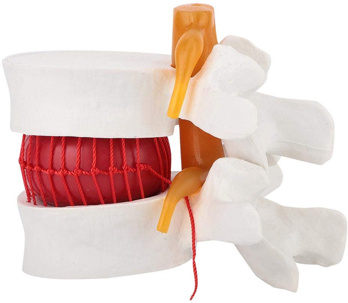 Lumbale Hernia Model 1:1,5 Wervelkolom Anatomische Studie Demonstratie Display Pedagogisch Hulpmiddel voor Onderwijs