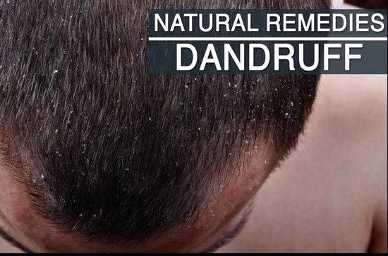VT - Natural Remedies for Dandruff - cover