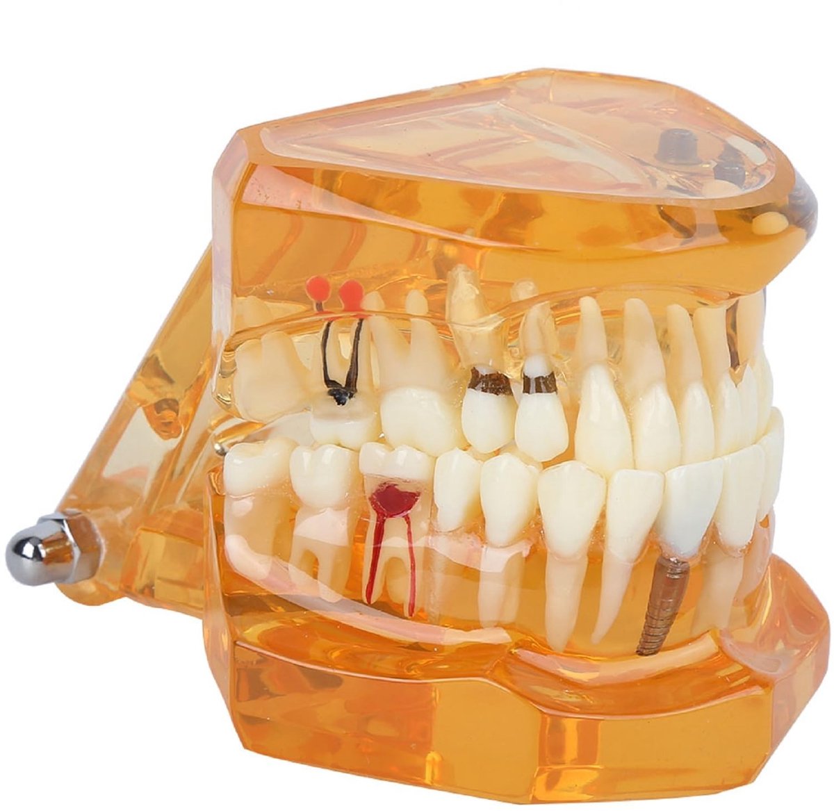 Dailygoods - Tandheelkundig Studie Model met Implantaten voor Educatie