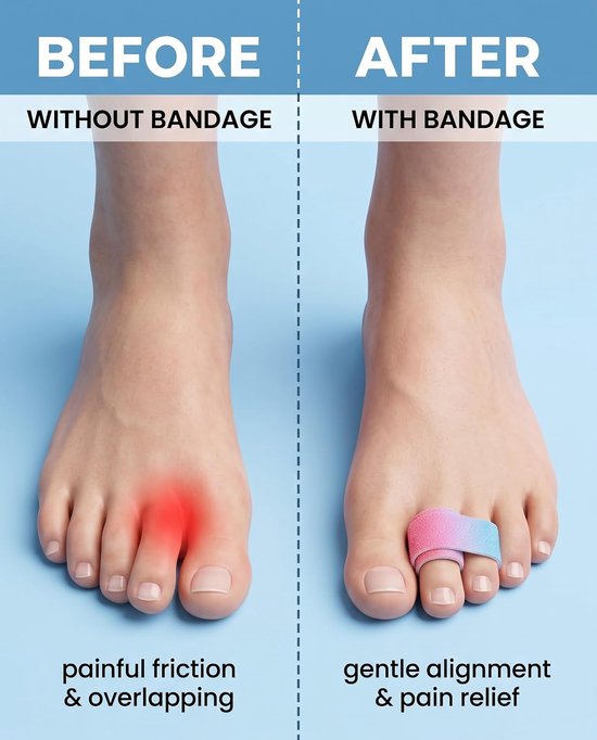 10 stuks zachte teenspreiders, verstelbaar, hamertenen, correctie, teenbandage, ademend, teenbescherming voor pedicure en nagellak, herbruikbaar, willekeurige kleuren — afbeelding 2