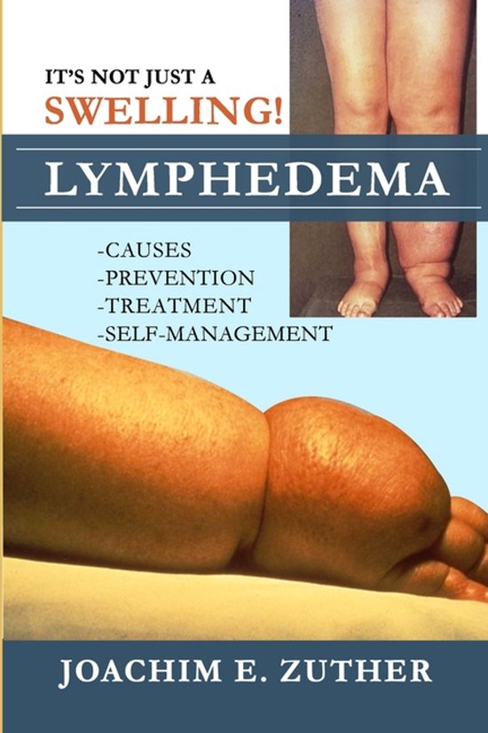 It's Not Just a Swelling! Lymphedema - cover