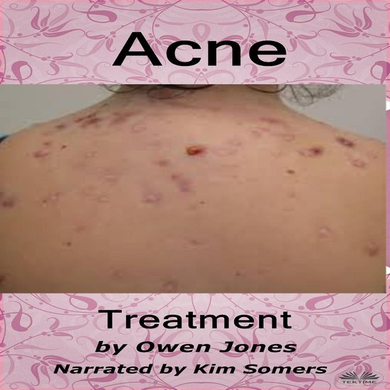 Acne Treatment - cover