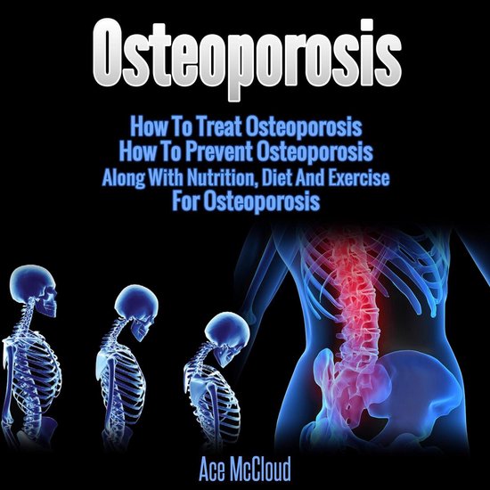 Osteoporosis: How To Treat Osteoporosis: How To Prevent Oste ... - cover