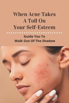 When Acne Takes A Toll On Your Self-Esteem: Guide You To Walk Out Of The Shadow