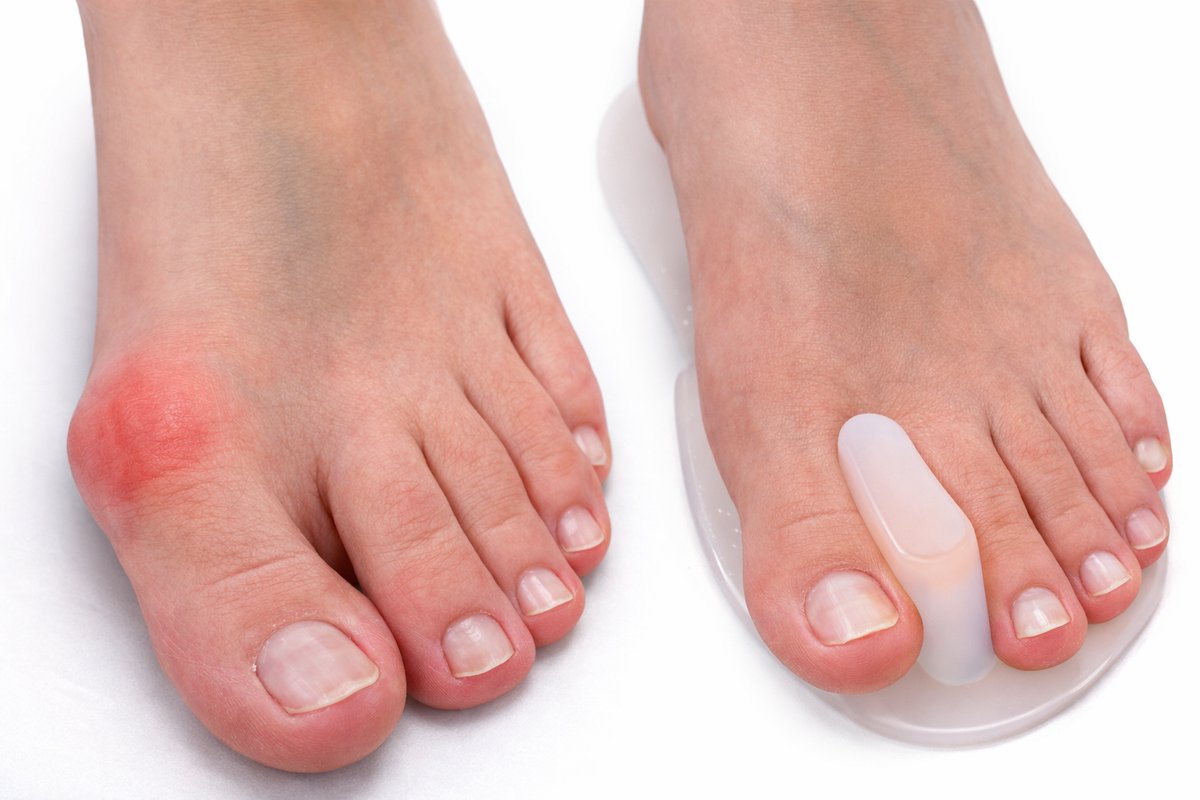 Uriel - Teenspreider - Hallux valgus - Voorvoetkussen - Gel - Drukverlichting - 1 paar