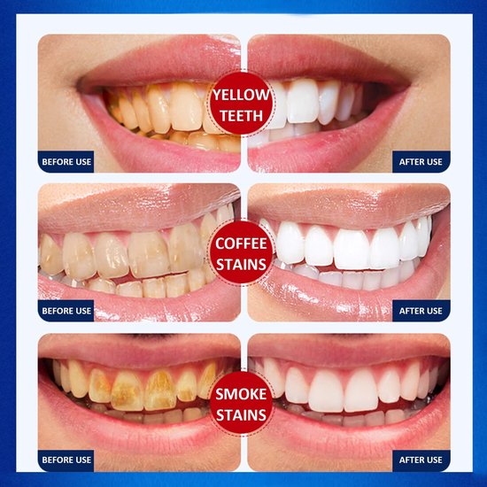 White Teeth / Teeth Whitening Strips, Whitening Strips for Sensitive