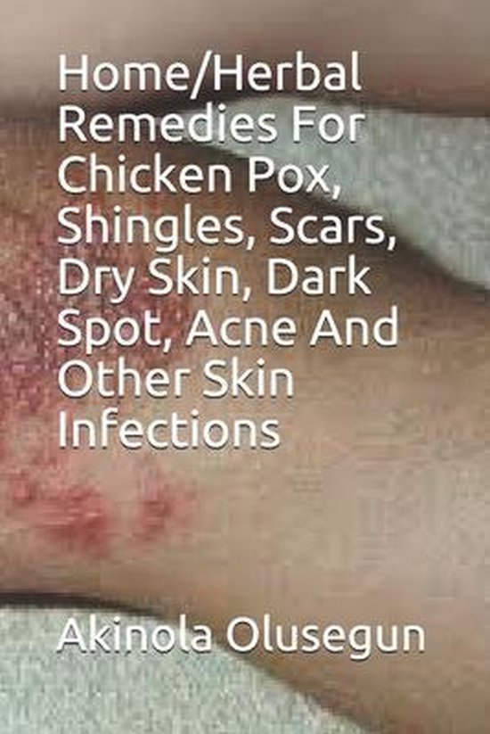 Home/Herbal Remedies For Chicken Pox, Shingles, Scars, Dry Skin, Dark