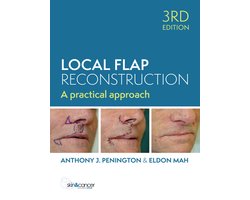 Local Flap Reconstruction