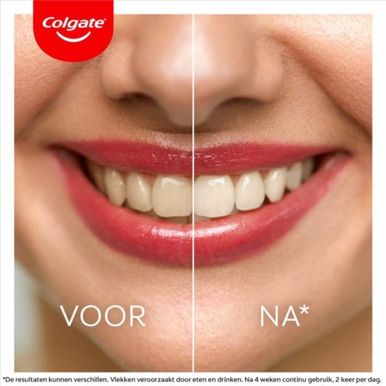 Voor-en-na foto van een lachende mond met wittere tanden na gebruik. Tekst: 'Voor' en 'Na*'.