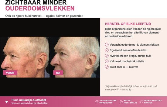 Twee afbeeldingen van Mark (87): links 'voor' met ouderdomsvlekken, rechts 'na' met een egalere huid.