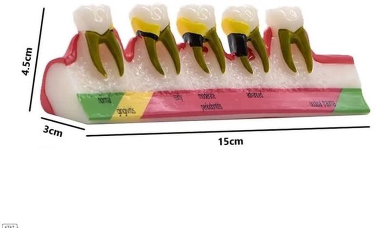 Parodontitis Model - Hars - Weergavemodel - Tandheelkundige Aandoeningen - Gingivitis - Chronische Parodontitis - Duidelijke Weergave - Tandheelkundig Model