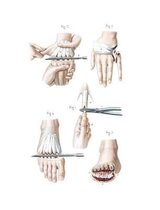 Amputations in the Continuity of the Bones Composition Notebook