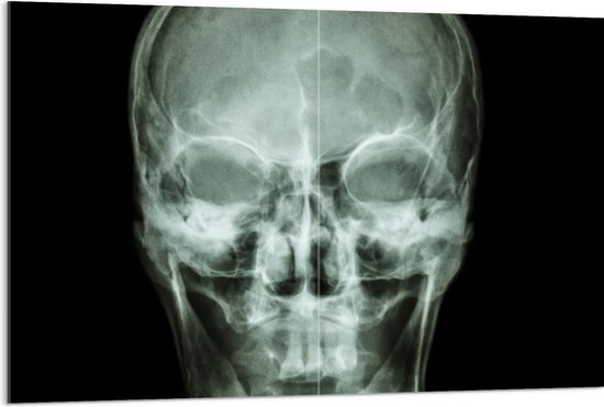 Acrylglas - Röntgenfoto van Mensenschedel - 120x80 cm Foto op Acrylglas (Wanddecoratie op Acrylaat)